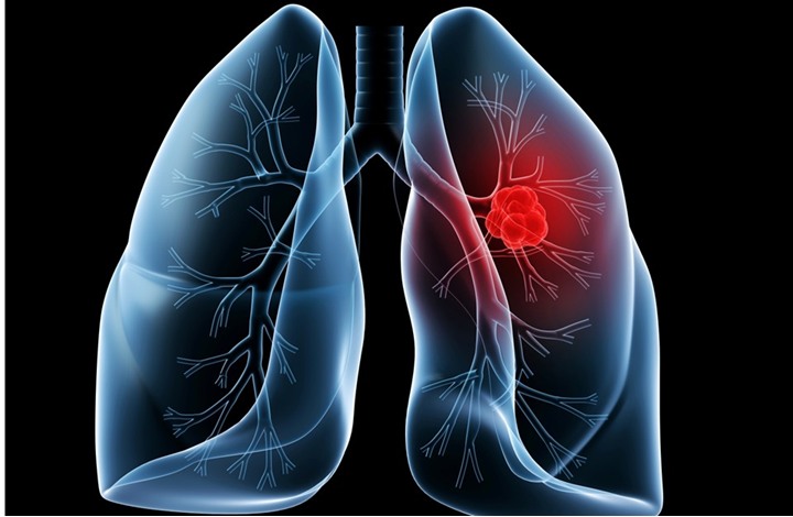 عقار يثبت فاعليته في علاج سرطان الرئة